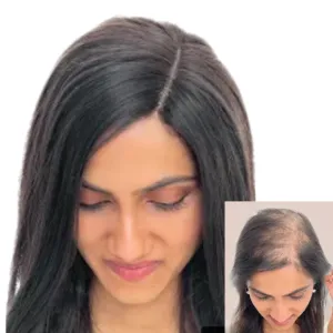 LavishTop Natural Scalp Hair Topper